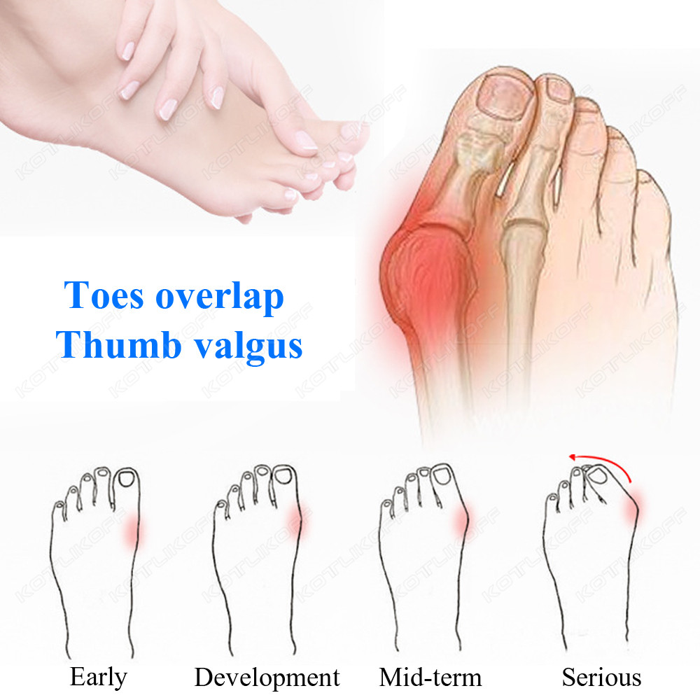 Punta protettiva Dita dei pied - Toe Separator Silicon recensione e prezzo